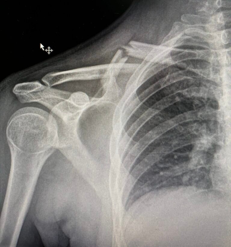 ¿Cuál es la diferencia entre esguince y fractura? Aprende a identificarlos