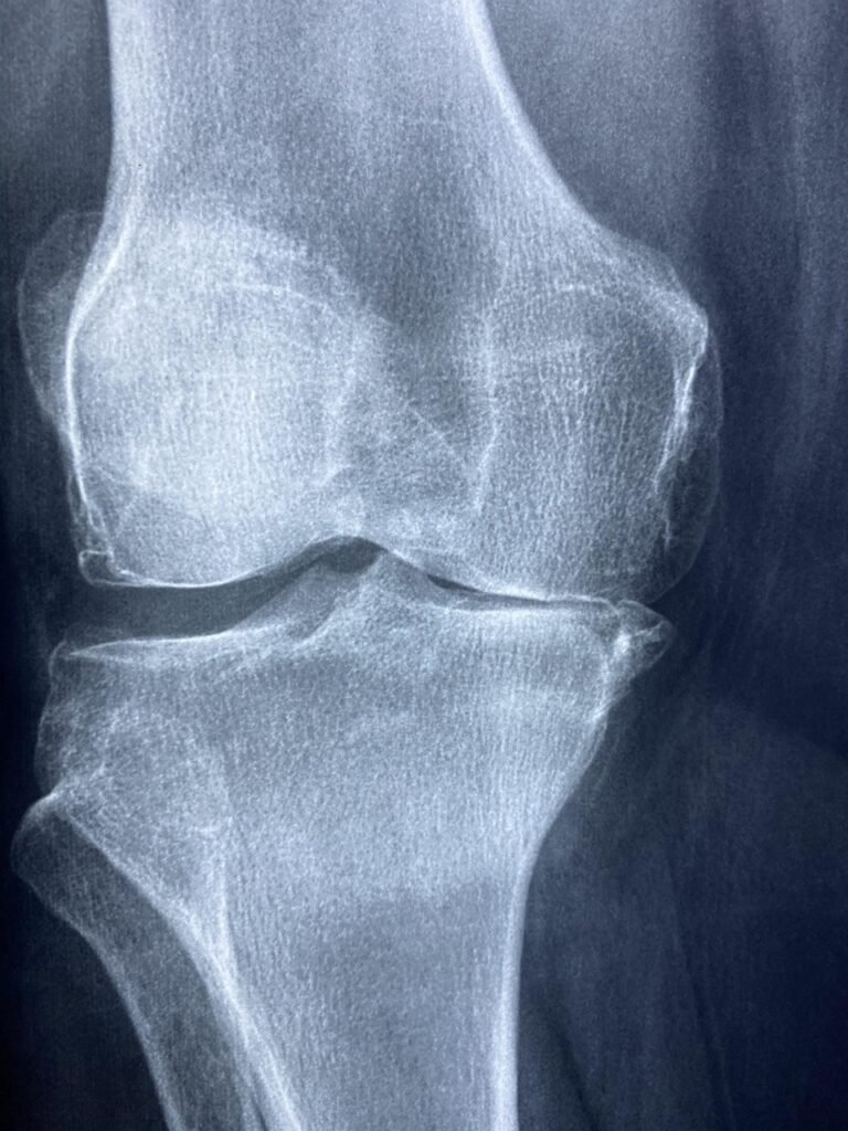 knee, x rays, arthritis, skeleton, health, patient, cartilage, orthopedics, anatomy, medicine, injury, joint, disease, diagnosis, inflammation, hospital, knee, arthritis, arthritis, arthritis, arthritis, arthritis